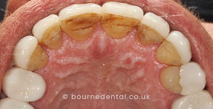 Teeth Whitening After