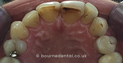 Teeth Whitening Before