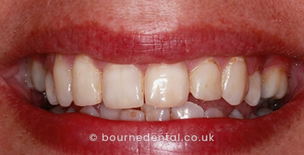 Teeth Whitening After