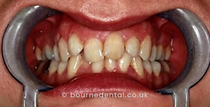 Teeth Whitening Before