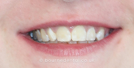 Teeth Whitening Before