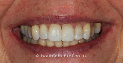 Teeth Whitening After