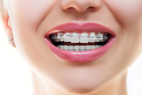 Braces