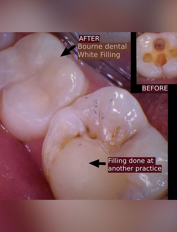 White Fillings