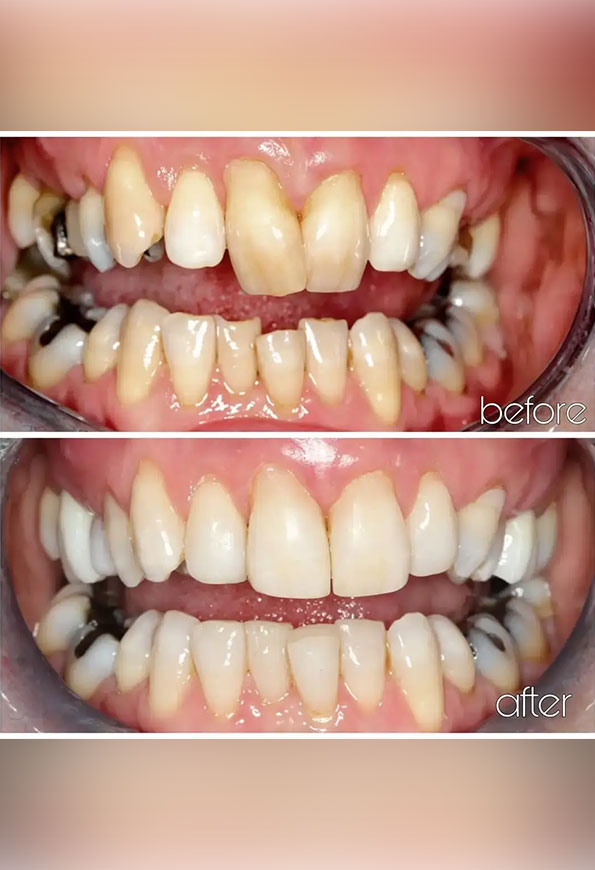 Comprehensive Tooth Wear Treatment