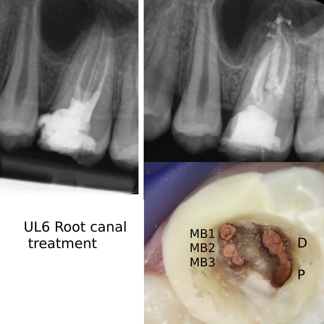Complex Retreatment