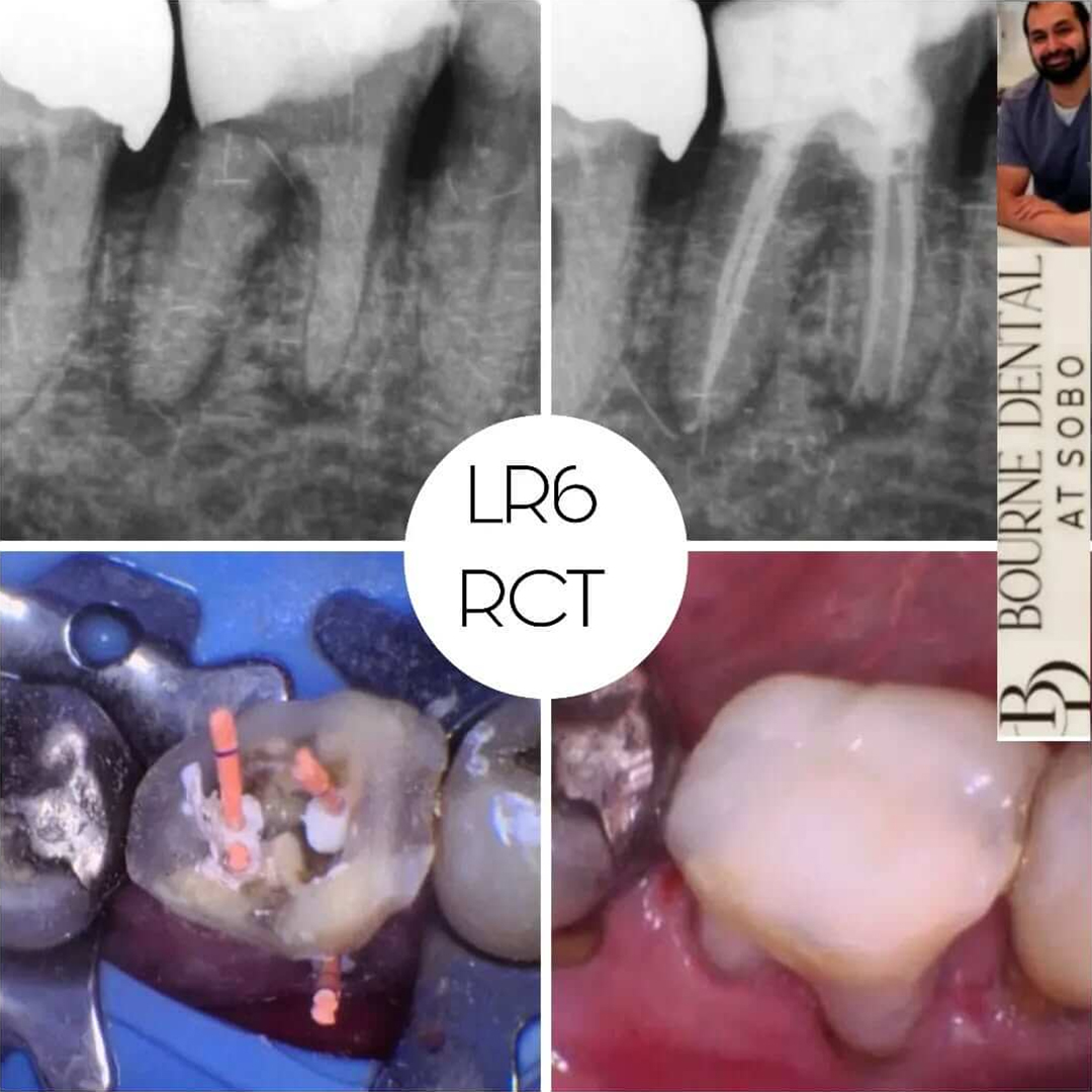 Sclerosed Canals