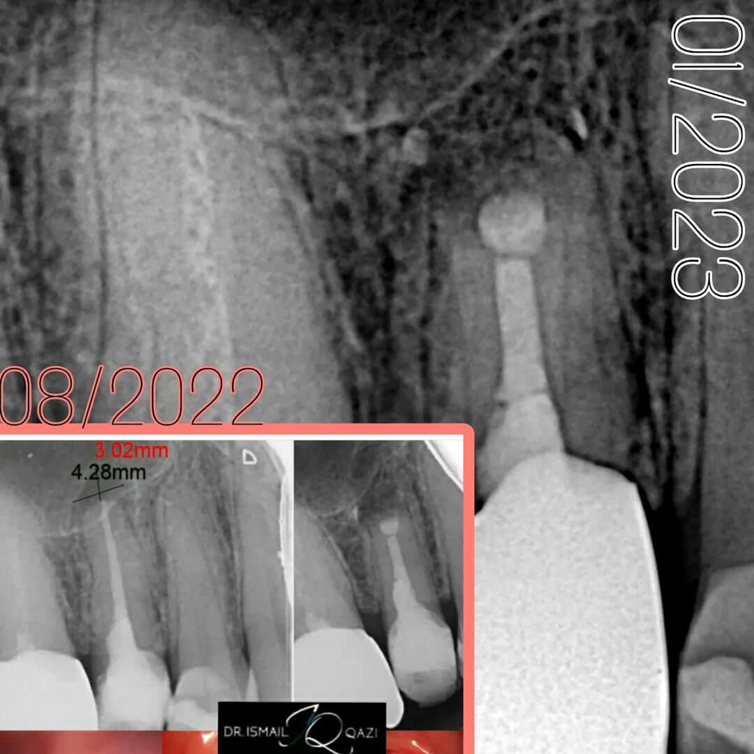Apicetomy Procedure