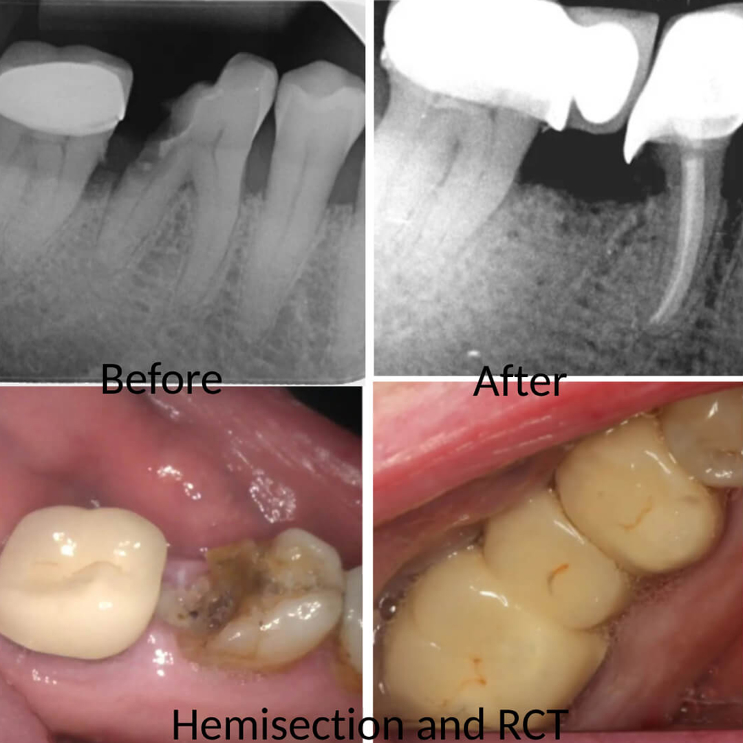 Hemisection Procedure
