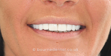 Composite Bonding & Teeth WhiteningAfter