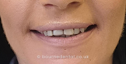 Composite Bonding & Teeth WhiteningBefore