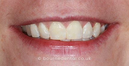 Teeth Whitening After