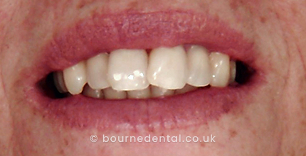 Teeth Whitening Before