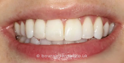 Composite Bonding After