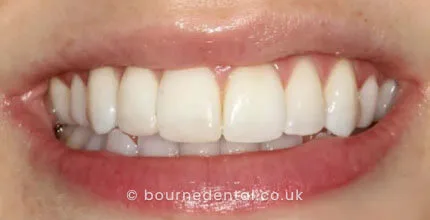 Composite Bonding After