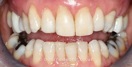 Composite Bonding After