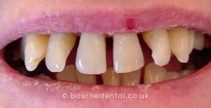 Composite Bonding Before