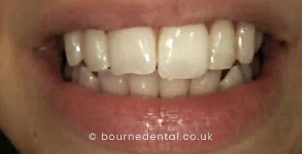 Composite Bonding Before