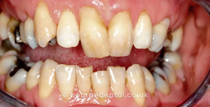 Composite Bonding Before
