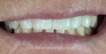 Composite Bonding & Teeth WhiteningAfter