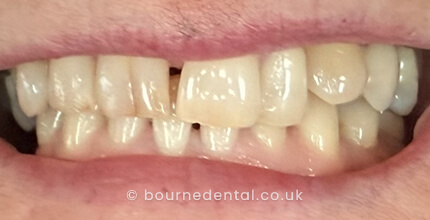 Composite Bonding & Teeth WhiteningBefore