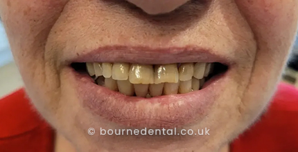 Dentures After