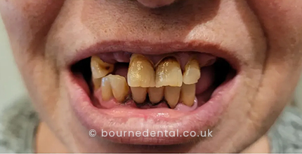 Dentures Before