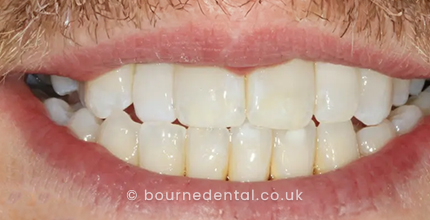 Smile Makeover After