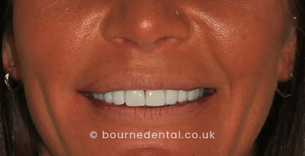 Smile Makeover After