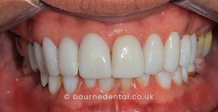Smile Makeover After
