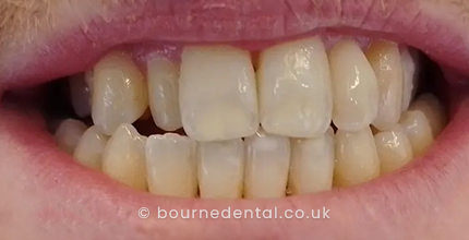Smile Makeover Before