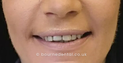Smile Makeover Before