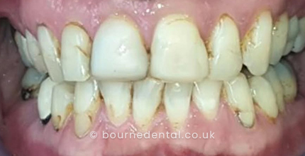 Smile Makeover Before