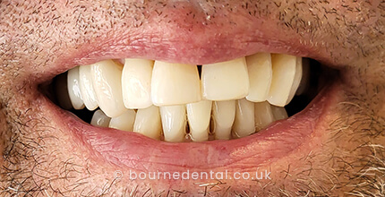 Teeth Whitening After