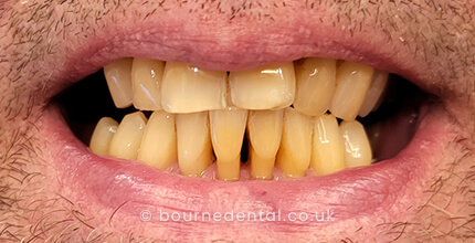 Teeth Whitening Before