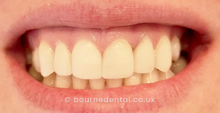 veneers After