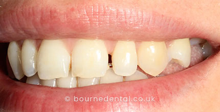 veneers Before