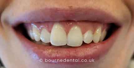 White Spot Removal After
