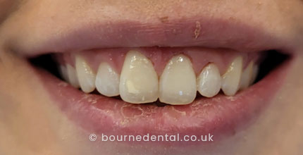 White Spot Removal Before