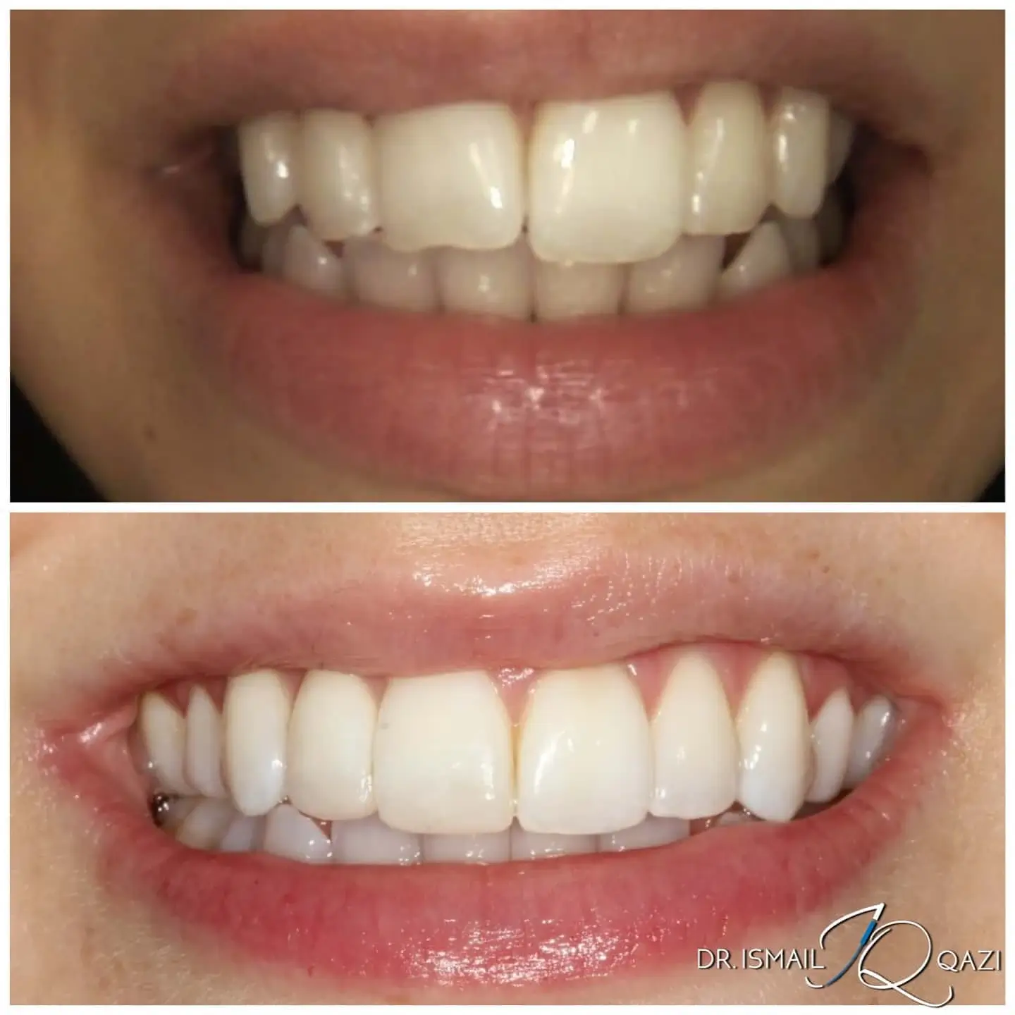 Composite bonding result - chips repaired