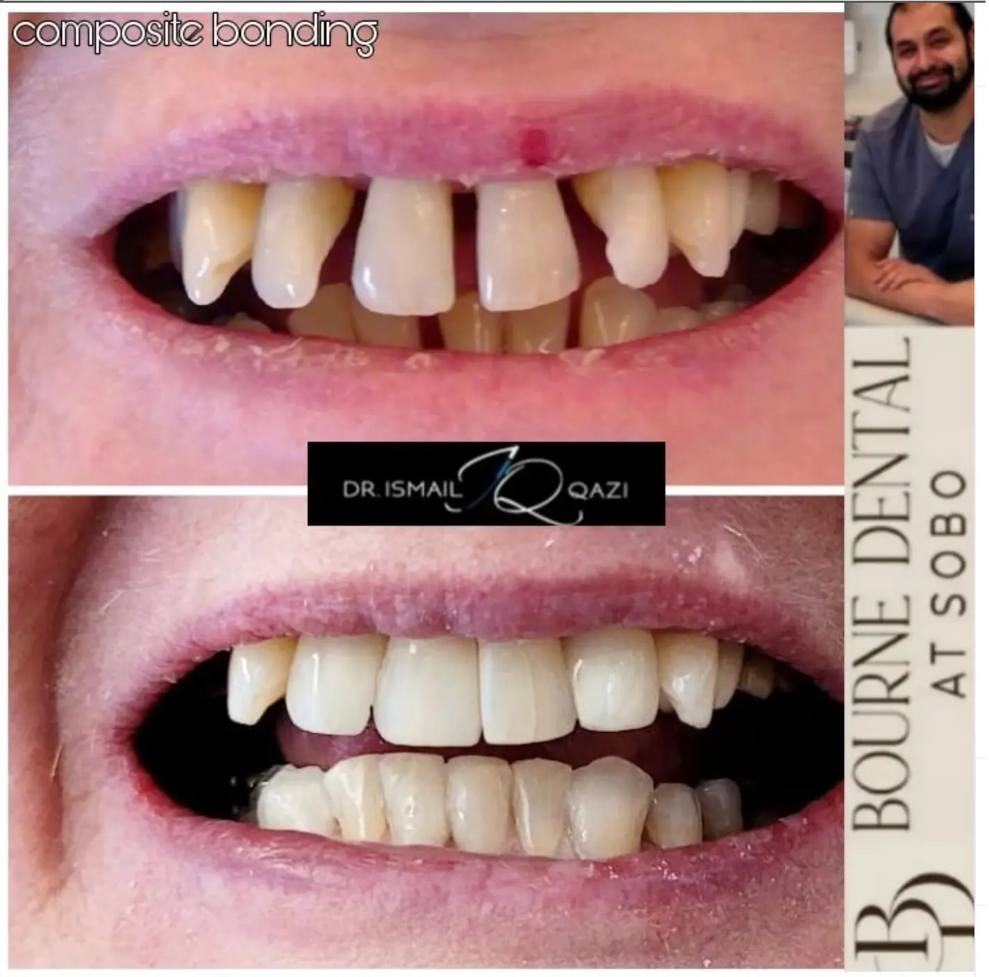 Composite bonding result - closed gaps