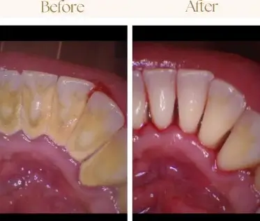 Dental hygienist performing teeth cleaning at Bourne Dental