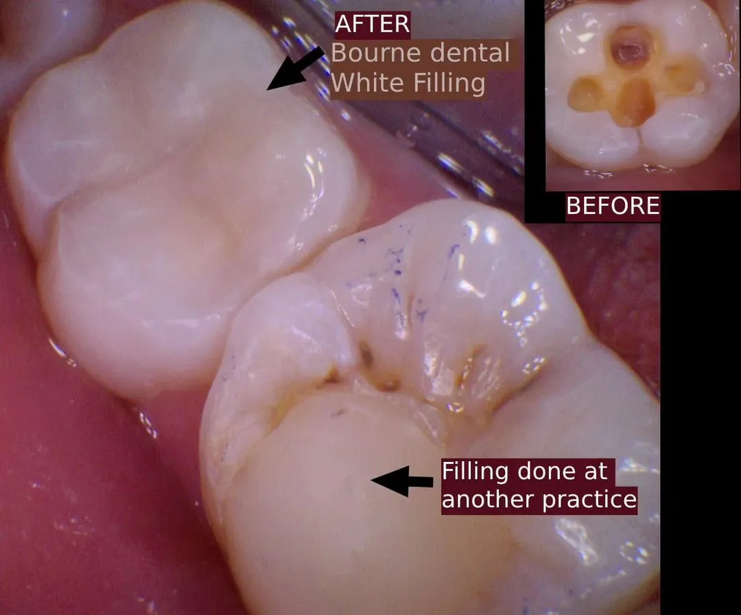 bourne dental fill