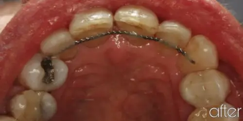 second ortho case after 