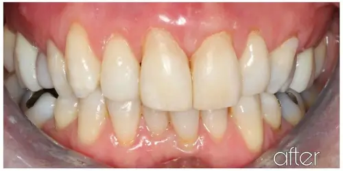 third ortho case after 