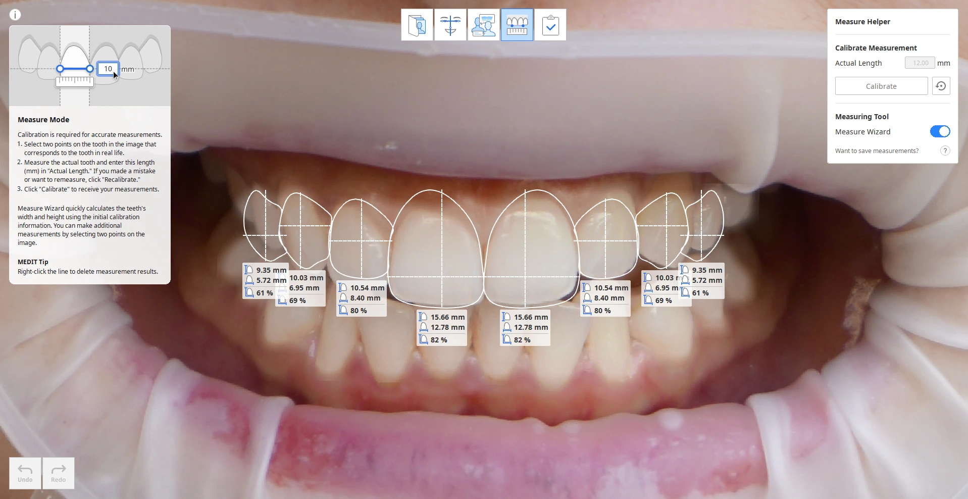 Digital smile design process at Bourne Dental