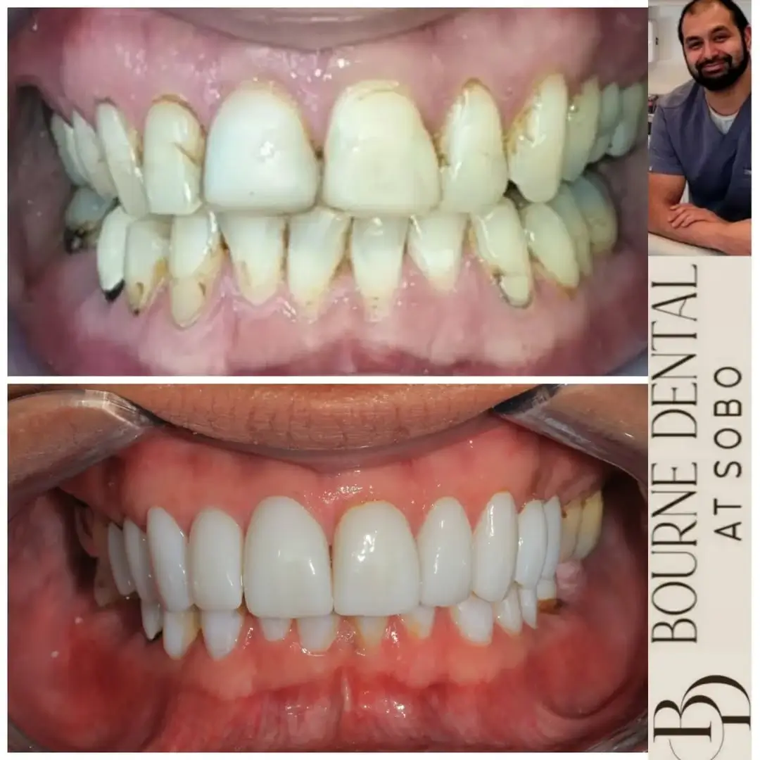 Smile makeover before and after at Bourne Dental Bournemouth