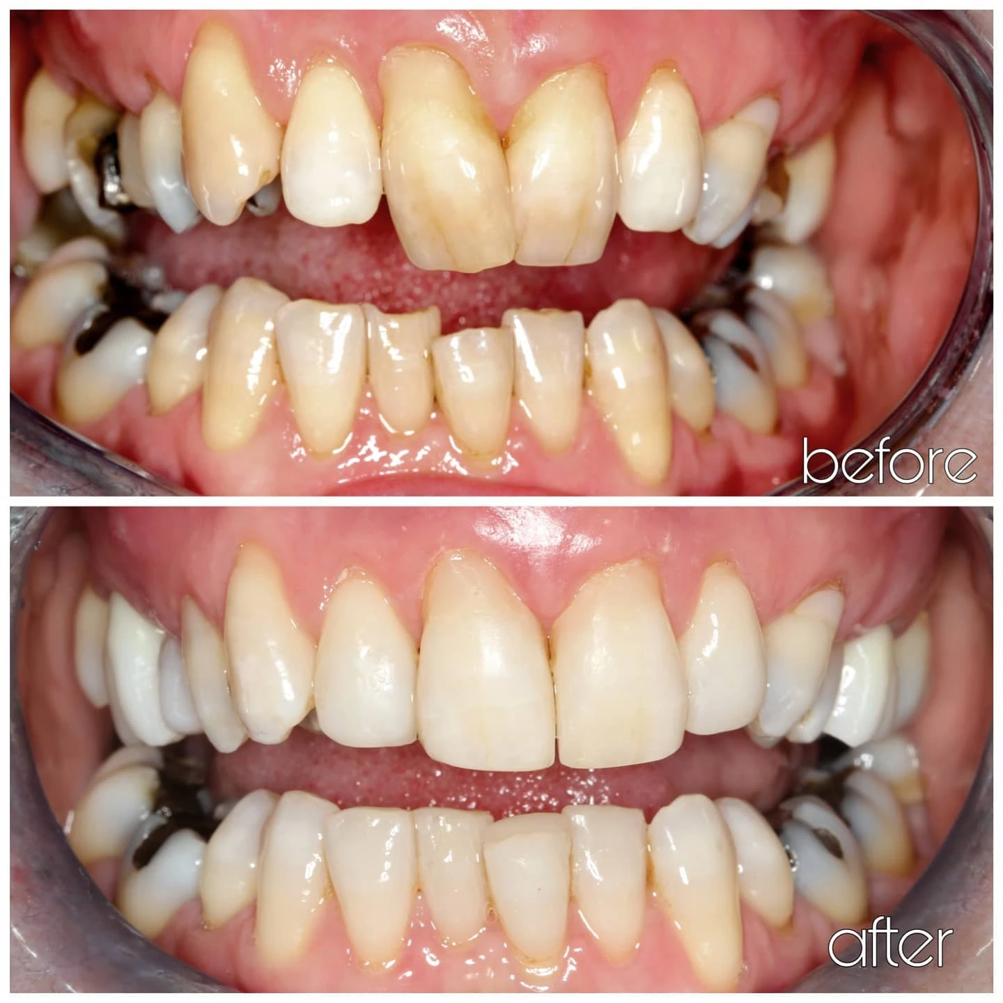 Composite bonding result - stains covered