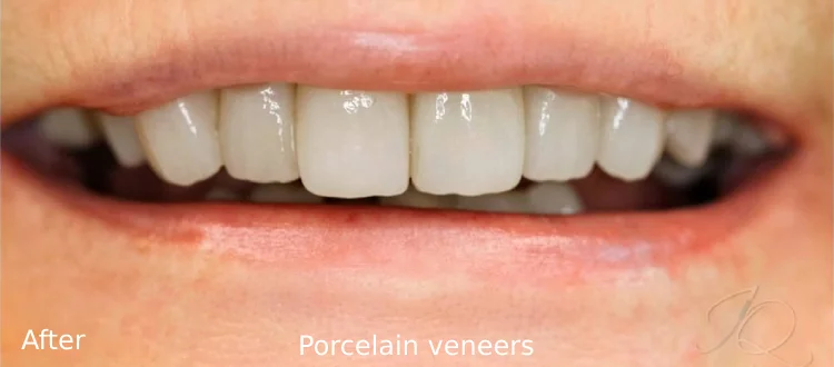 first veneer case after 