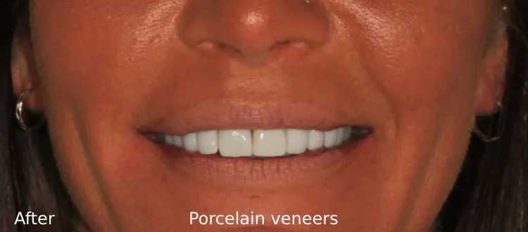 second veneer case after 